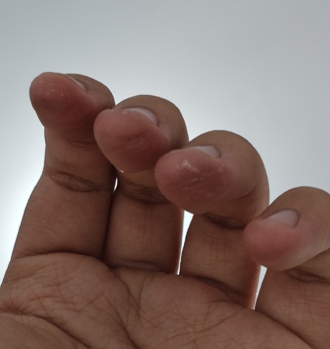 练琴磨破的手